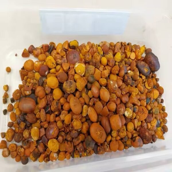 Gallstones